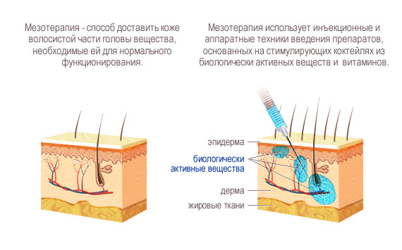 Мезотерапия (волосы)