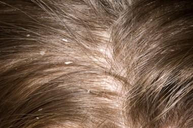 Себорея кожи головы – лечение в сети клиник НИАРМЕДИК