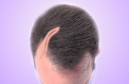 Пересадка волос в область шрама